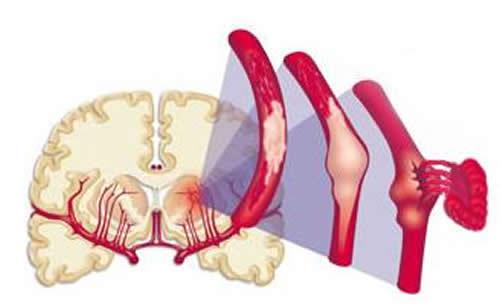 脑出血能治好吗,脑出血能完全康复吗,脑出血可