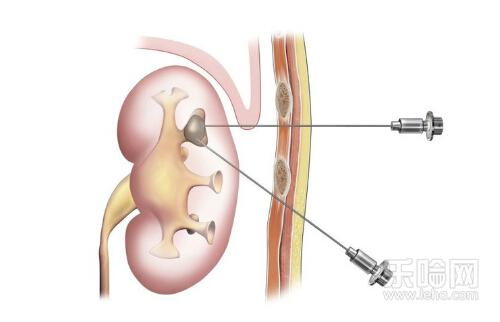 肾积水严重吗能治好吗,肾积水严重吗怎么治疗