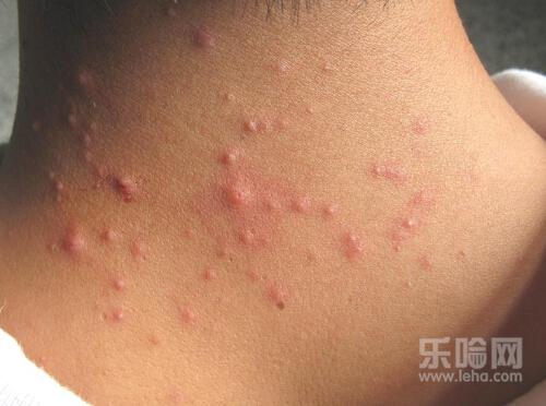 毛囊炎多久才能好,毛囊炎多久会自愈-乐哈健康