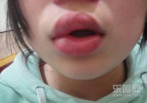 吃无花果会过敏吗,无花果会过敏吗,无花果过敏