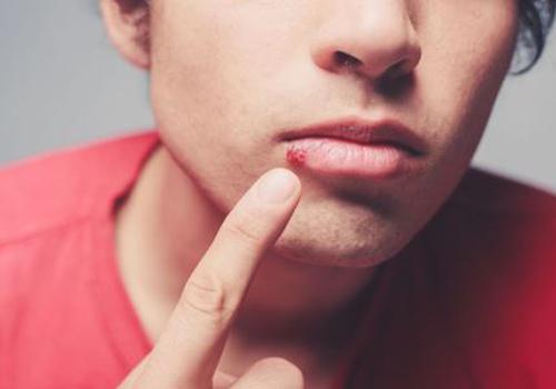 嘴角起泡是怎么回事