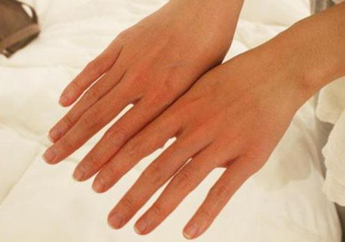 日晒伤皮肤特征