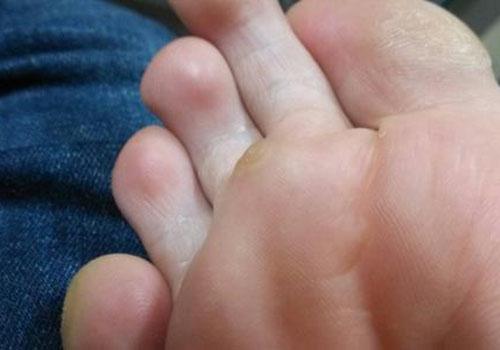 鸡眼是怎么形成的,鸡眼有什么表现-乐哈健康网