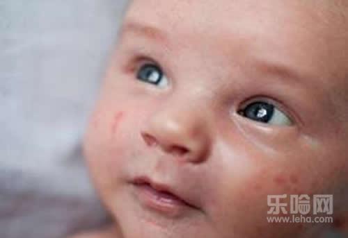 小孩皮肤过敏怎么办,小孩皮肤过敏怎么办才好