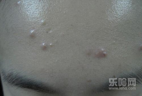 闭口粉刺怎么形成的,闭口粉刺形成的原因-乐哈