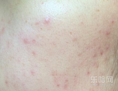 口粉刺会自己消失吗,封闭性粉刺自己会好吗-乐