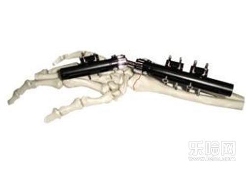 骨折外固定支架什么时候拆除-乐哈健康网