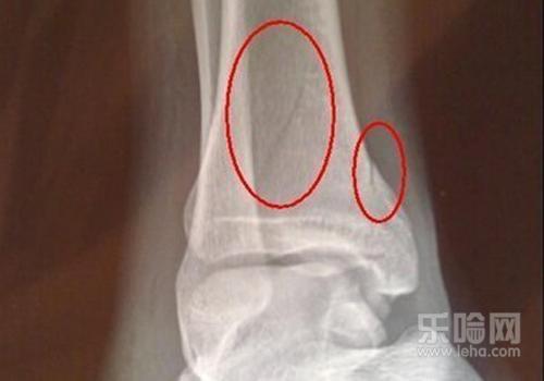 骨折多久能消肿,骨折消肿需要多久,骨折多长时