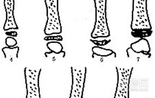 骨龄测试怎么测,测骨龄怎么测,如何测试骨龄-乐