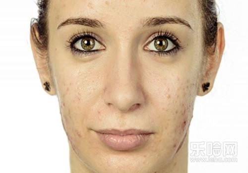 脸上过敏怎样快速消除,脸上过敏如何快速消除