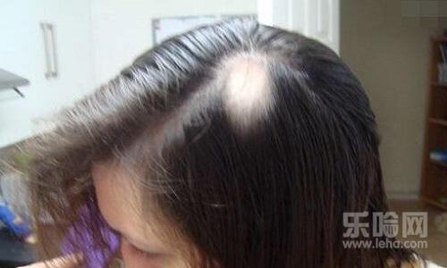 什么病导致掉头发,掉头发是有什么病吗,掉头发