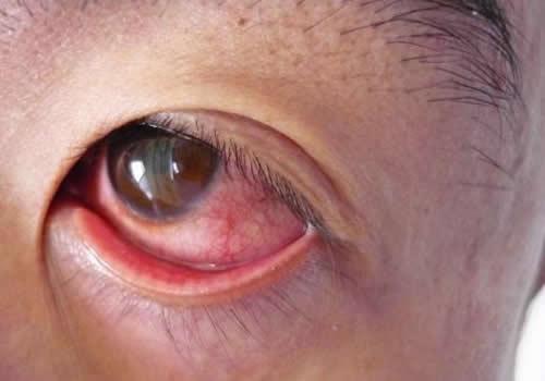 洗完澡后眼睛发红是为什么,洗完澡后眼睛发红