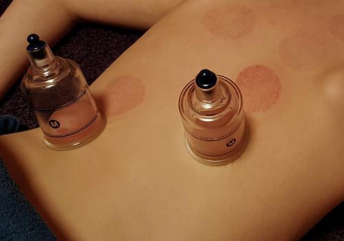 拔罐黑紫色说明什么,拔罐变黑紫后怎么调养