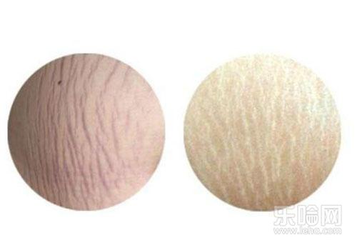 膨胀纹是怎么产生的,膨胀纹是什么原因-乐哈健