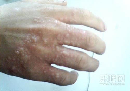 手背上起小水泡怎么回事,手背起了好多小水泡