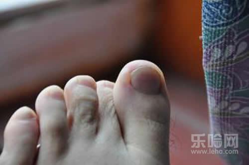 脚趾长水泡很痒怎么办,脚趾缝长水泡奇痒,脚趾