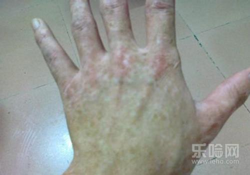 手背长斑是什么原因造成的,手背长斑是怎么回
