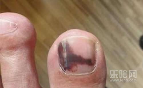 脚趾甲变黑是什么原因,脚趾甲变黑是怎么回事