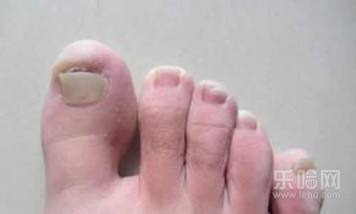 脚趾甲变厚是什么原因,脚趾甲为什么会变厚,脚