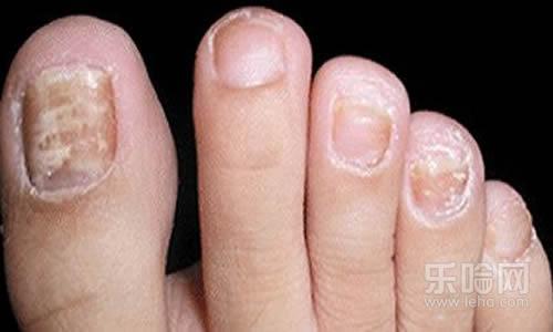 脚趾甲空了是什么原因,脚趾甲变空是怎么回事