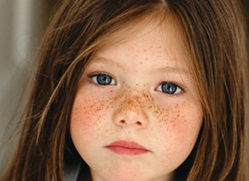 小孩脸上有斑怎么办,小孩脸上有斑怎么消除-乐