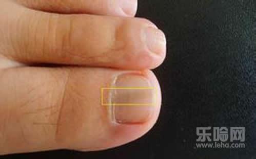 脚趾甲变黑是什么原因,脚趾甲变黑是怎么回事