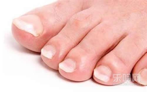 脚趾甲变厚是什么原因,脚趾甲为什么会变厚,脚