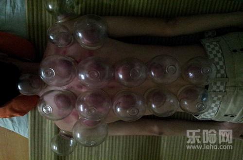 拔罐放血有什么好处,拔罐放血的好处和坏处-乐