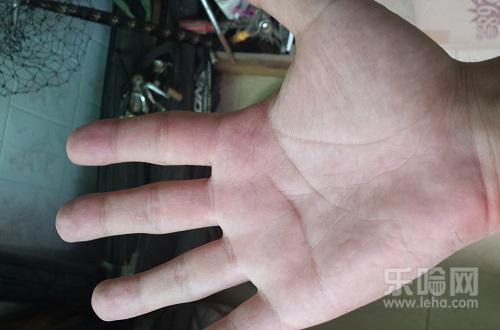 肝掌是什么样的