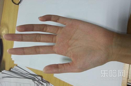 肝掌是什么样的,肝掌是怎么回事,肝掌是什么意