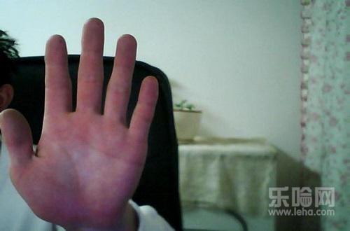 肝掌是什么样的,肝掌是怎么回事,肝掌是什么意