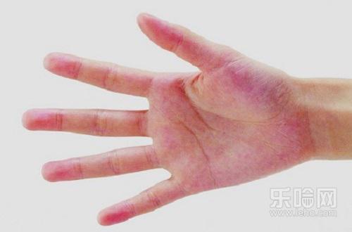 肝掌有什么症状,肝掌的症状有哪些,肝掌的症状