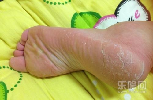 脚底干燥怎么办,脚底干燥脱皮怎么办,脚底干燥