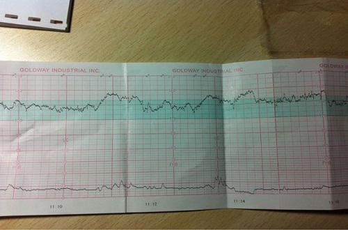 胎心监护图怎么看,怎么看胎心监护图,胎心监护