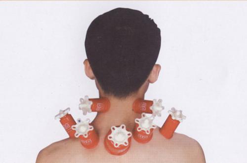 落枕拔罐的位置图,落枕拔罐管用吗-乐哈健康网