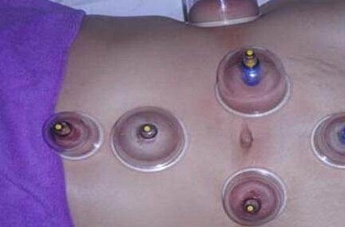 腹部拔罐可以减肥吗