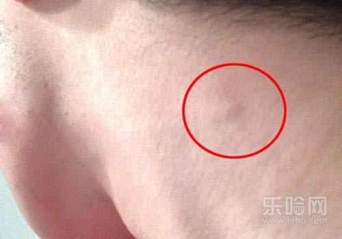 浅表性淋巴结肿大症状,浅表性淋巴结肿胀是什