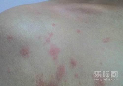 皮下出血点是什么原因,皮下出血是什么原因-乐