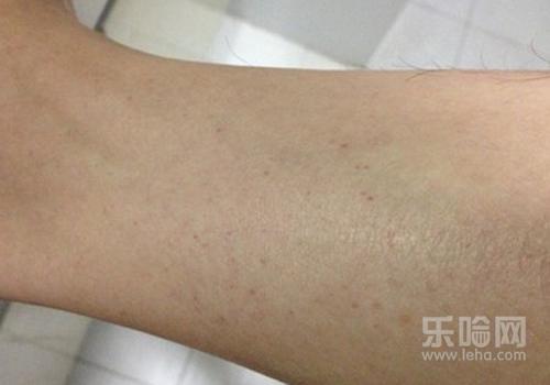 皮下出血点是什么原因,皮下出血是什么原因-乐