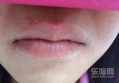 嘴巴脱皮是什么原因,嘴巴老是脱皮是什么原因