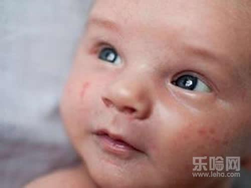 宝宝过敏怎么办,宝宝过敏怎么处理,宝宝过敏怎