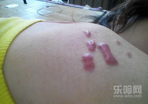 皮脂腺囊肿有什么危害,皮脂腺囊肿严重吗,皮脂