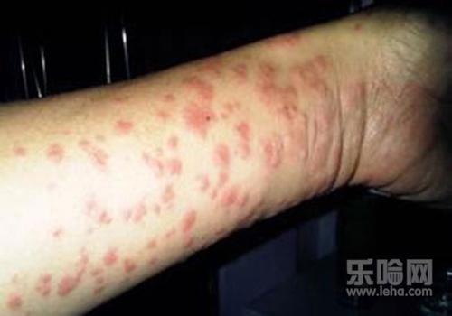 经常长湿疹是什么原因,湿疹反复发作的原因-乐