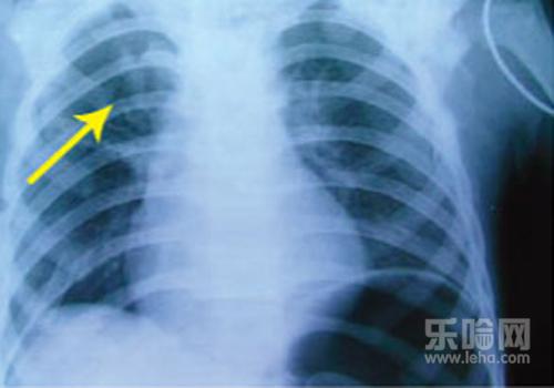 胰腺炎检查什么项目才能确诊,胰腺炎如何检查