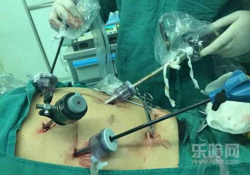 胆囊切除后有什么影响,胆囊手术的后遗症-乐哈健康网