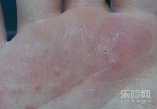 手心痒是怎么回事涨了很多小疙,手心痒是怎么