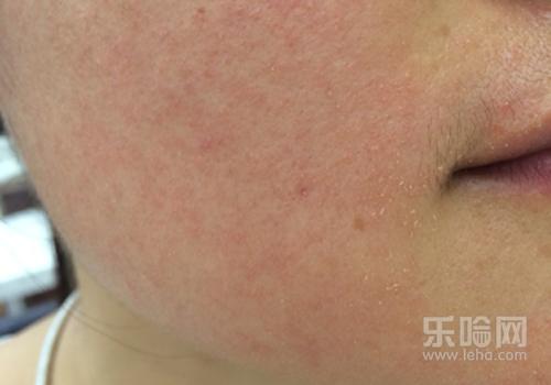 梦见脸脱皮用手撕下来_脸脱皮怎么办