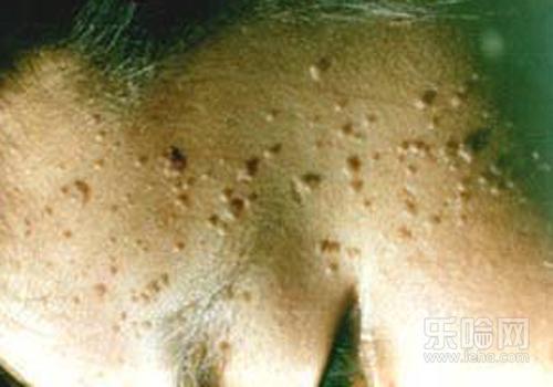 眼部扁平疣有什么危害,眼部扁平疣危害是什么-乐哈健康网