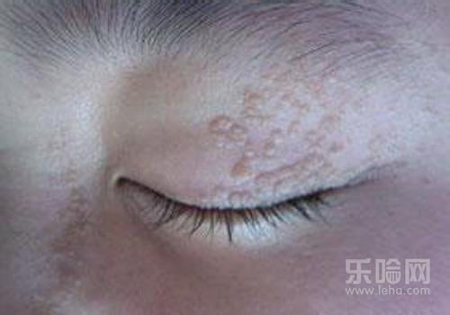 眼部扁平疣怎么去除,眼部扁平疣如何治愈,眼部