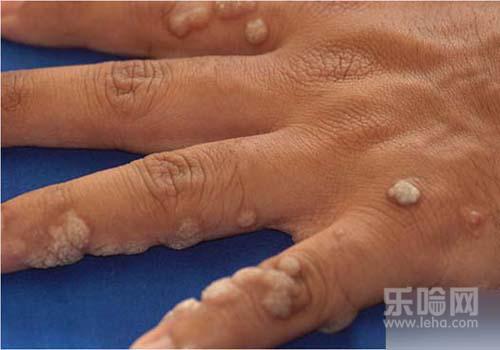 眼部扁平疣是怎么引起的,眼部扁平疣怎么形成